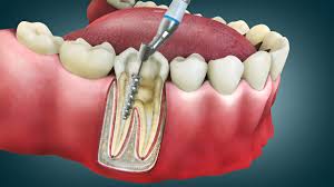 Root Canal Treatment Services